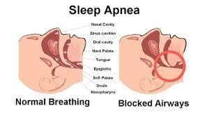 Obstructive Sleep Apnea 